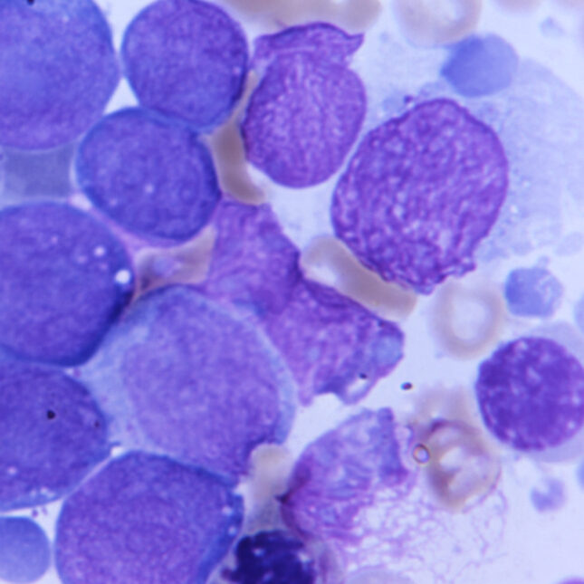 histopathology from patient with acute myeloid leukemia (AML)