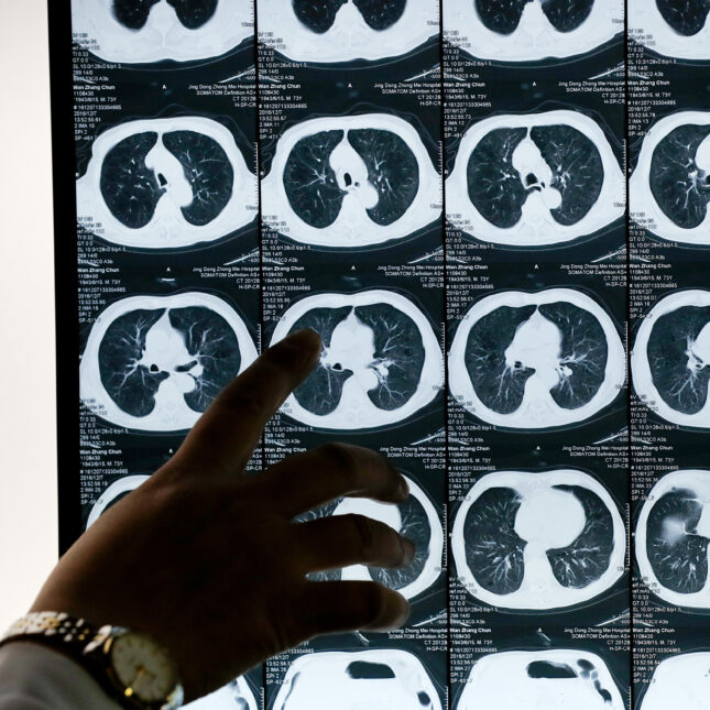 lung CT scan w/hand