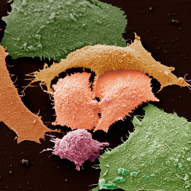 Colorized lung cancer cells